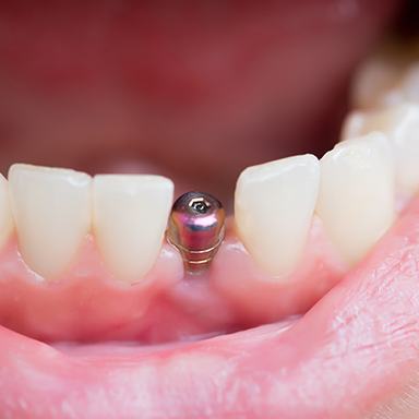 patient smiling with abutment in mouth