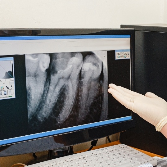 Digital x rays on chairside computer screen