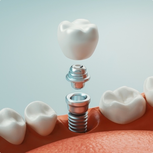 Animated smile during dental implant supported dental plan placement
