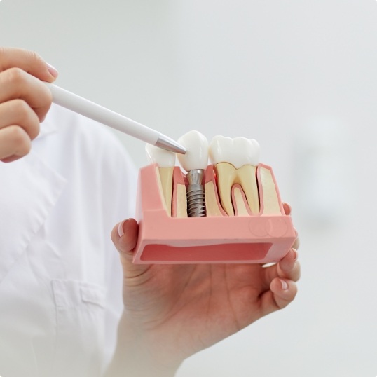 Model of natural teeth compared to dental implant supported replacement tooth