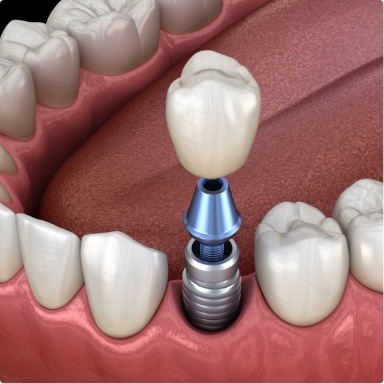 Animated smile during dental implant supported single tooth replacement