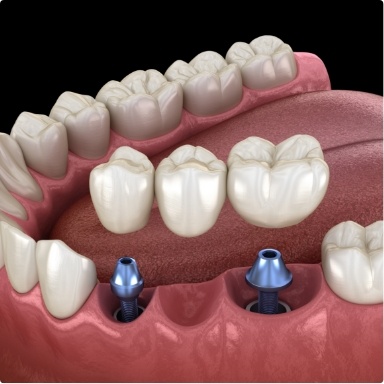 Animated smile during dental implant supported fixed bridge placement