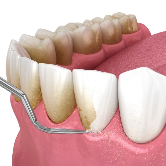 Animated smile during scaling and root planing gum disease treatment