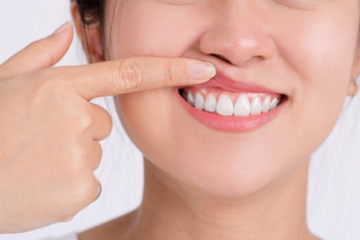Woman showing off her gums