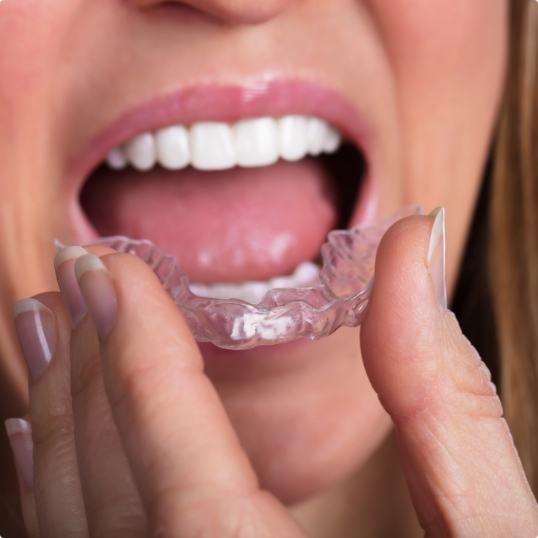 Closeup of dental patient placing a nightguard for bruxism