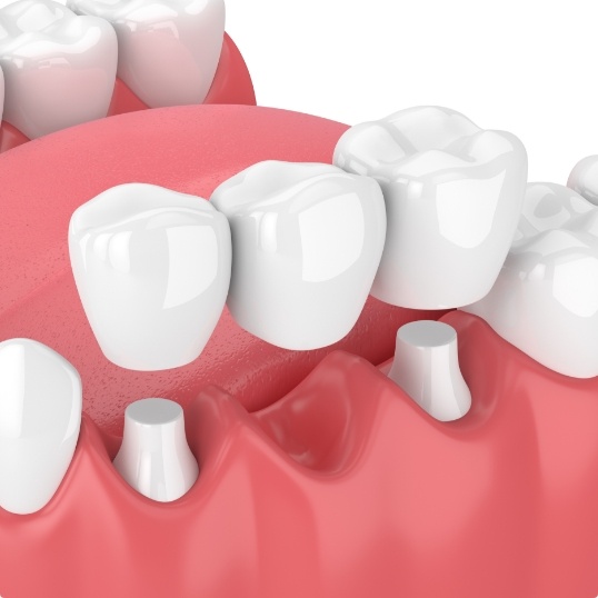 Animated smile during dental bridge placement