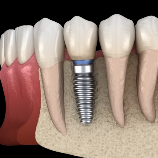 Animated smile with dental implant supported dental crown