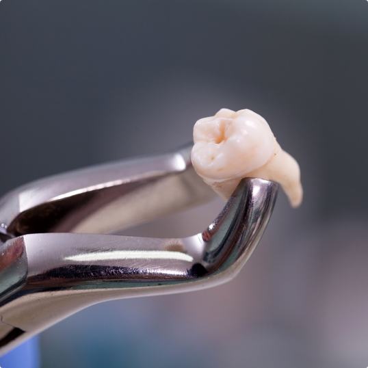 Metal clasp holding an extracted tooth