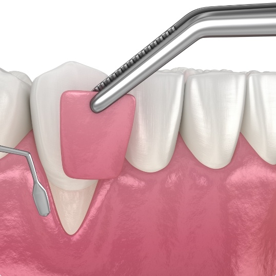 Animated smile during bone grafting treatment