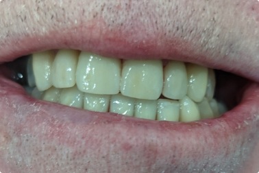 Closeup of bright healthy smile after cosmetic dentistry