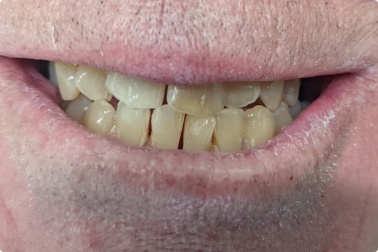 Closeup of yellowed smile before cosmetic dentistry