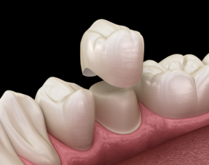 a closeup of a dental crown being placed