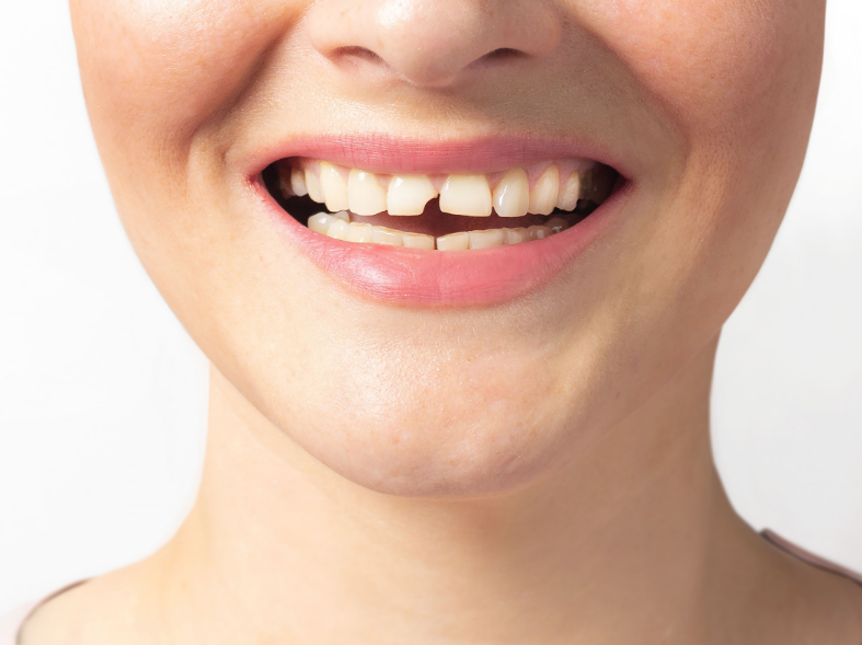 Woman smiling with chipped tooth